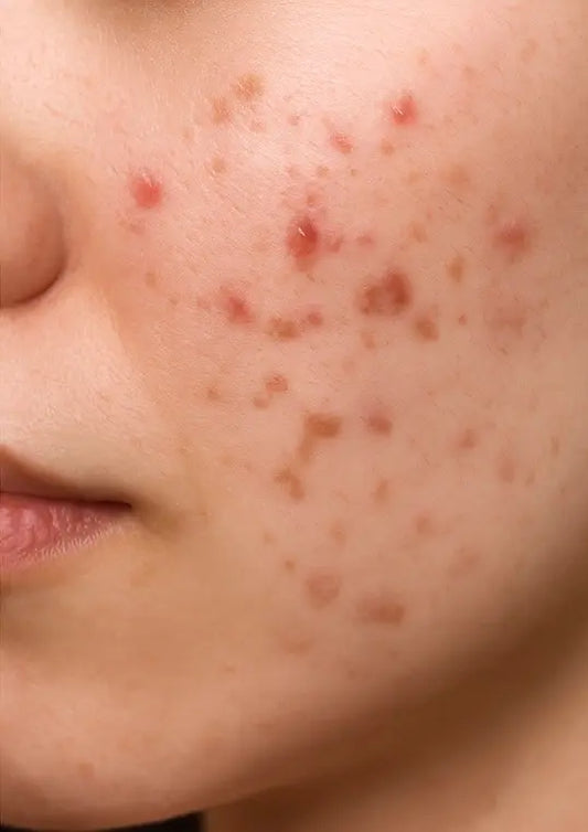 Piel con brotes y manchas de acne