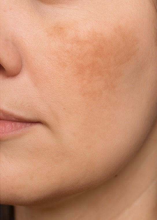 Mujer con manchas por melasma