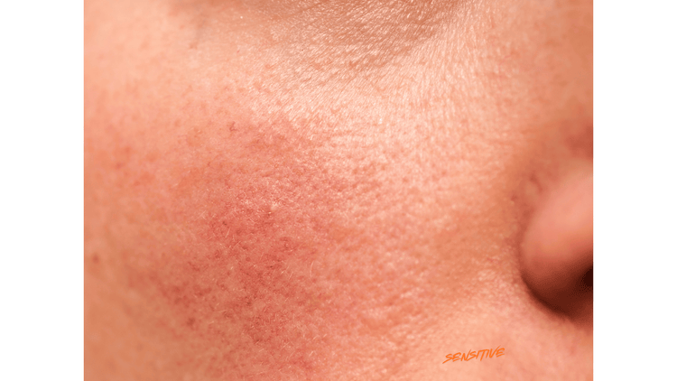 Piel sensible con rosacea